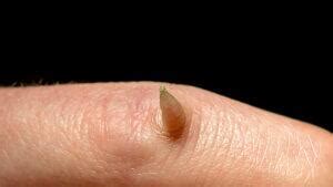 cutaneous horn symptoms treatments  risk factors