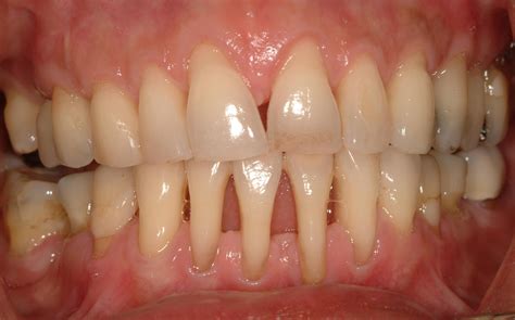 how to reverse gum disease 10