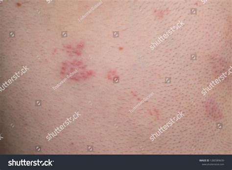 shingles disease herpes zoster blisters  shutterstock