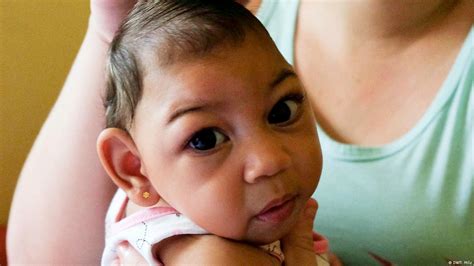 Fotos De Criança Com Microcefalia - A cada dia uma pequena vitória: a vida com microcefalia