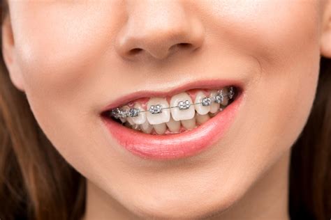 how long do you need to wear braces
