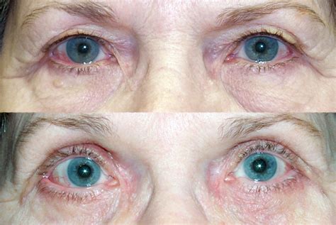 Cosmetic eyelid surgery, oculofacial Oculo-facial) surgeon locate