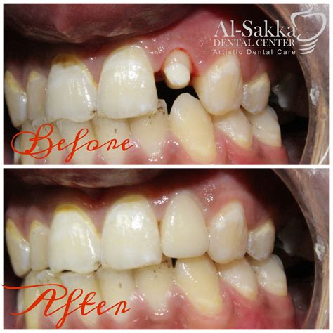 🔥Placement of Fiber post after... - Al-Sakka Dental Center | Facebook