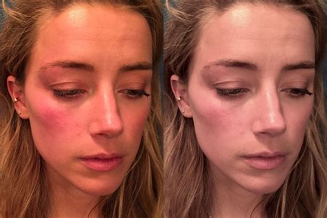 Amber Heard Injury Photos at Jason Rocha blog