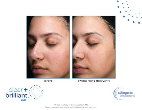 Clear + Brilliant - Healthy Complexions Spa