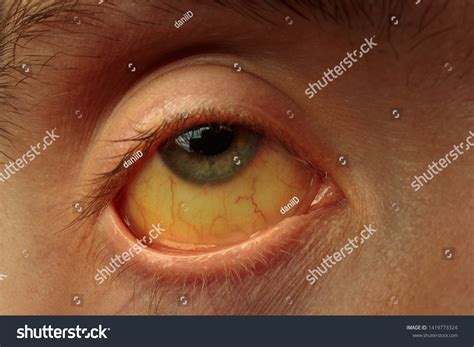 Yellow Staining Sclera Eye Diseases Liver Stock Photo (Edit Now) 1419773324