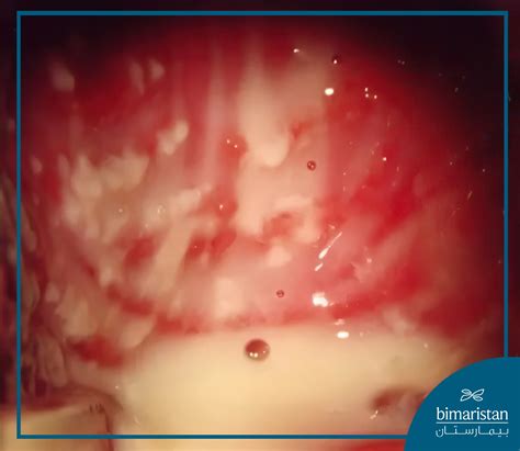 Vulvovaginitis Sores 💢 Vaginitis Is An Inflammation Of The Vagina
