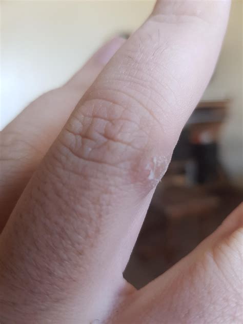Has anyone else got a blister/calloused skin from playing on a ps4 pad