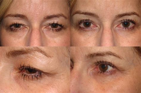 Scar Eyelid Surgery Upper at Meagan Burlingame blog