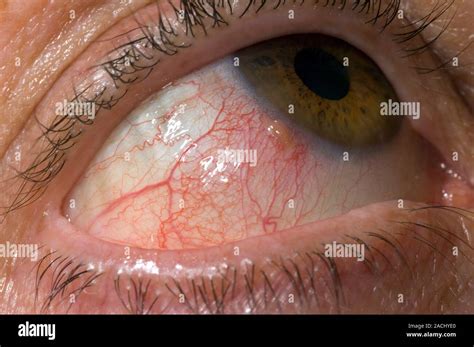 Sclera Inflammation SCLERITIS