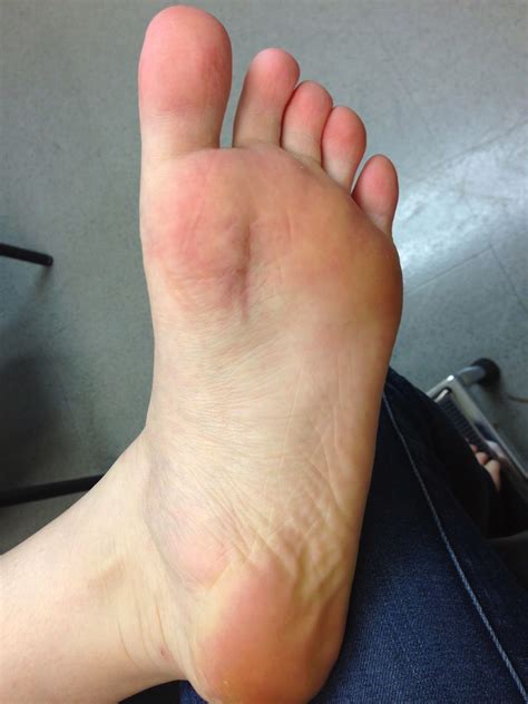 Taylor's Foot Story