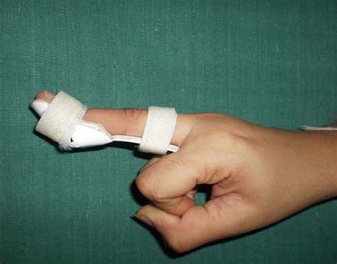 spoon finger splint   price  mumbai  mahavir surgicals id