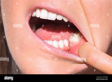 closeup  woman mouth  tooth   jaw missing tooth