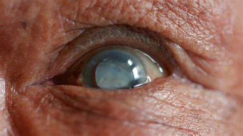 cataracts  headaches  surprising connection