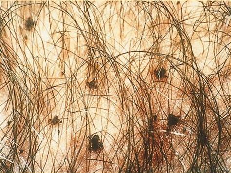 Pediculosis pubis — Википедија