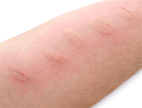 Psoriasis Injection Stock Photos, Pictures & Royalty-Free Images - iStock