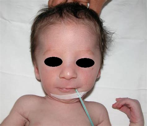 Prader Willi Syndrome Symptoms