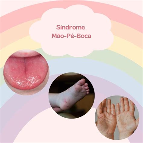 Mao Pe E Boca Bebe - Mãos, Pés e Boca - Afinal o que é? - Clínica Crescendo