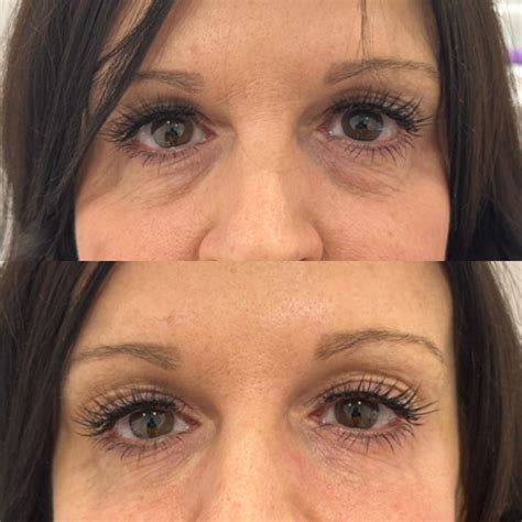 Samantha’s Under Eye Transformation