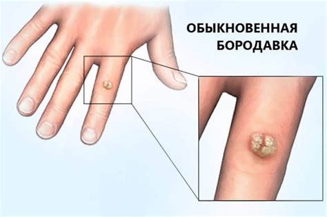 Как удалить бородавку на пальце руки криофарма - фото презентация