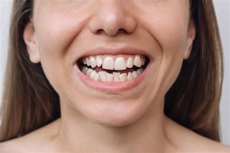 What Causes Crooked Teeth and How To Fix Them?
