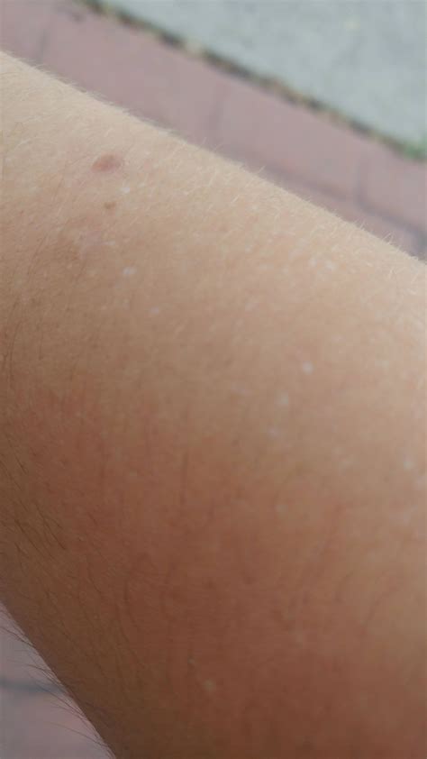 [Skin Concerns] White dots? : SkincareAddiction