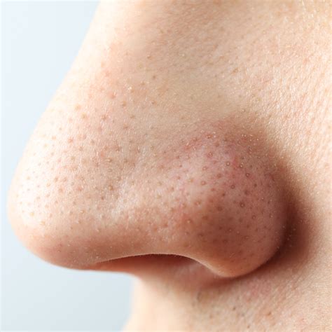 enlarged pores   nose men dermica medesthetics