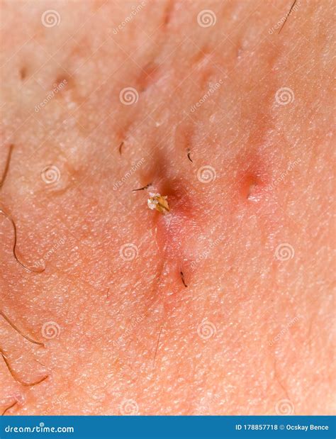 how do i get rid of an ingrown pubic hair 11