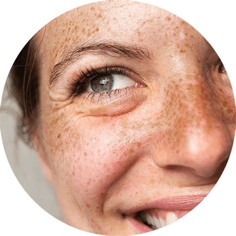 como tratar  prevenir manchas de sol na pele