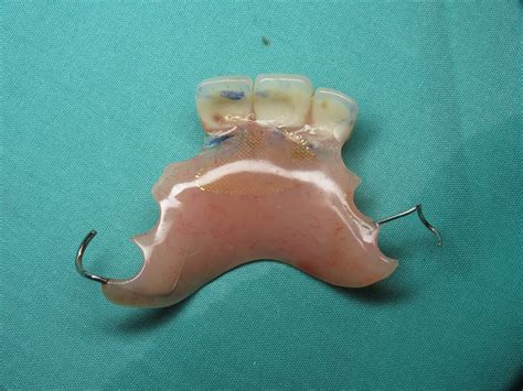 essix Archives - Burbank Dental Implants