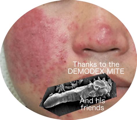 Why Demodex Mites Symptoms and Infestation Require Immediate Attention ...