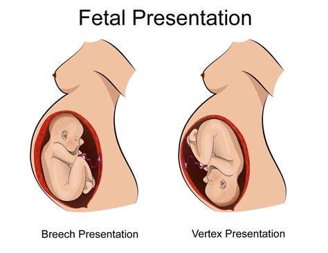 Breech Presentation and Birth Asphyxia