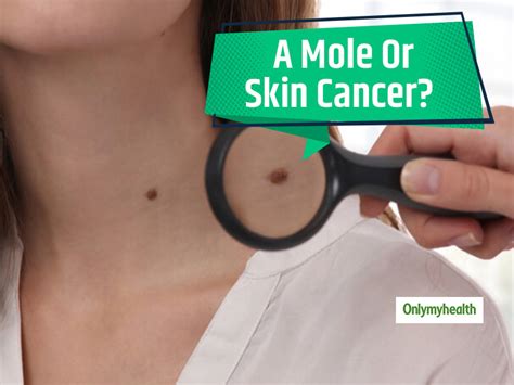 difference  mole  melanoma recognize skin cancer