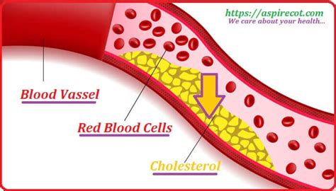 High cholesterol? causes and risk of high cholesterol. - AspireCot.Com