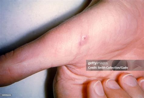 lesion  cat scratch disease skin  thumb image courtesy cdcdr