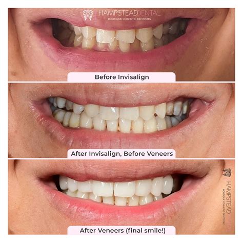 clear path   perfect smile  benefits  invisalign hampstead