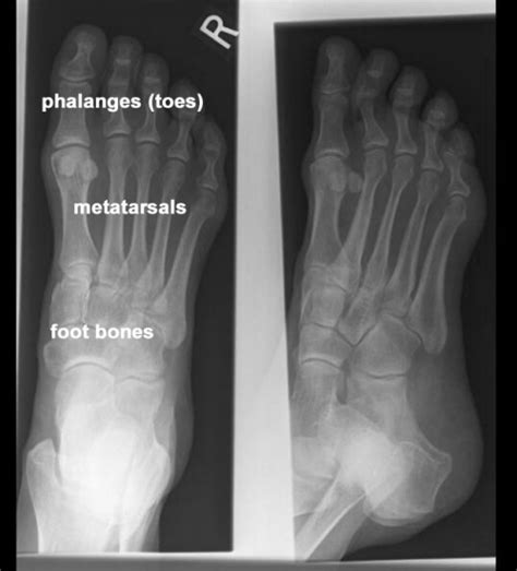 Medical School • X-ray image of a normal adult foot