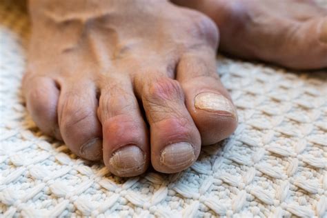 Gout Patients Who Stop Uric Acid-Lowering Medication Take More Steroids