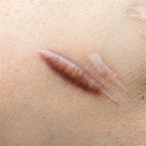 Keloid Treatment in Toronto | Keloid Scar Removal in Toronto