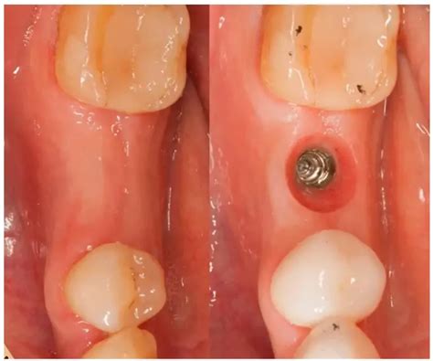 Tooth Extraction, Healing Implantation (part 2)