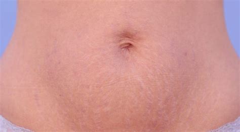 Do Stretch Marks Go Away When You Lose Weight? Here's the Truth ...