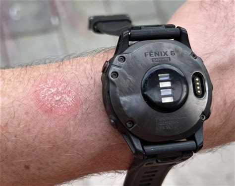 Fenix 6 - Skin burn - rash - fēnix 6 Series - Wearables - Garmin Forums