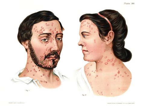 Primary Syphilis