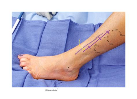 Superficial Peroneal Nerve Release in the Lower Leg | Surgical ...