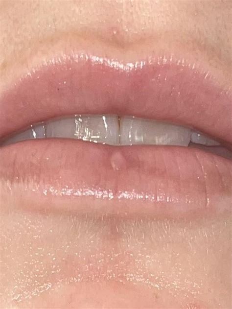 Over 3 months since i removed vertical labret, any tips/recs for ...