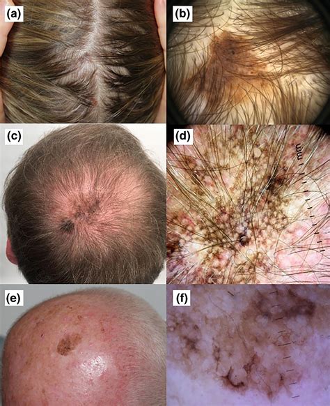Melanoma Scalp