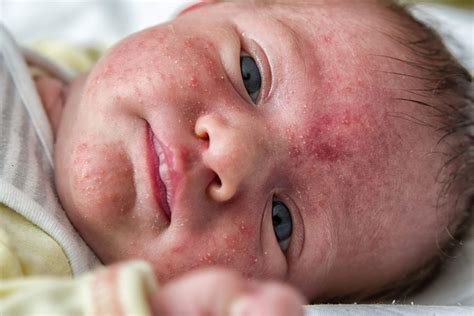 Acne Neonatal Quanto Tempo Dura - Tratamiento del acné neonatal - Eres Mamá