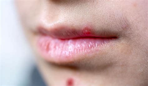 Espinha Na Boca Significado - Espinha na boca: saiba como tratar e prevenir? - Clinica OralDents