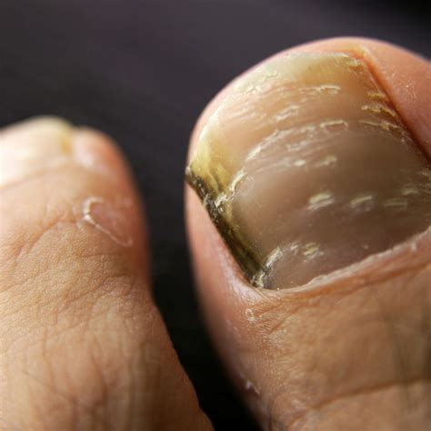 black toenail fungus