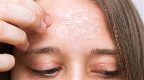 9 Causes For Dry Skin On Your Face & How To Treat Them